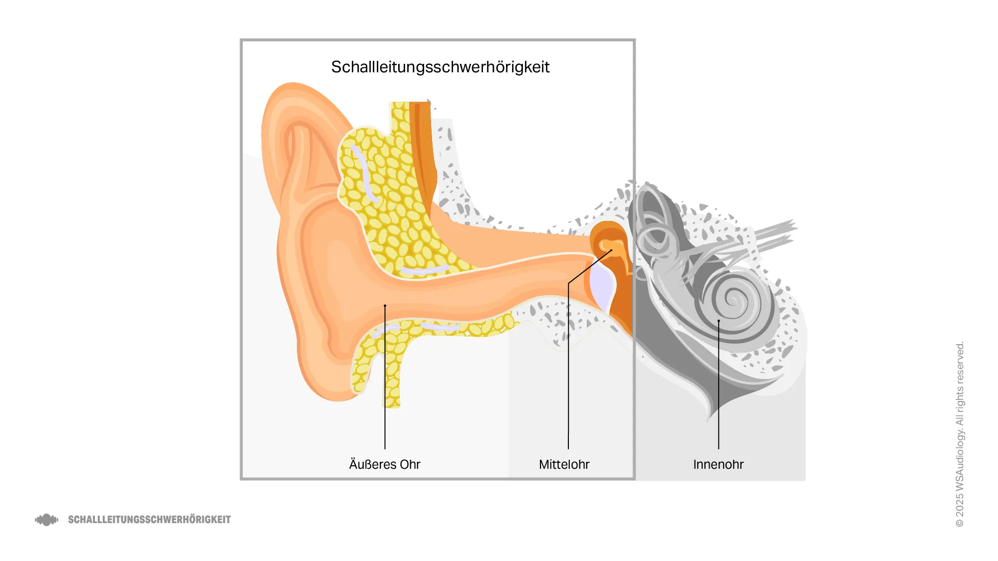 Illustration eines Schallleitungshörverlusts, der zeigt, wie Schall im Mittelohr blockiert wird und die Schallübertragung reduziert.