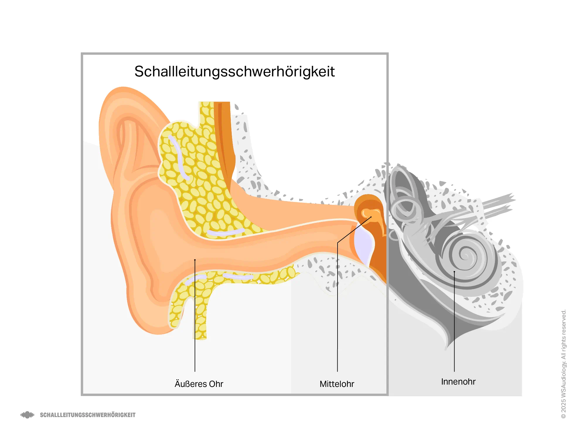 Illustration eines Schallleitungshörverlusts, der zeigt, wie Schall im Mittelohr blockiert wird und die Schallübertragung reduziert.