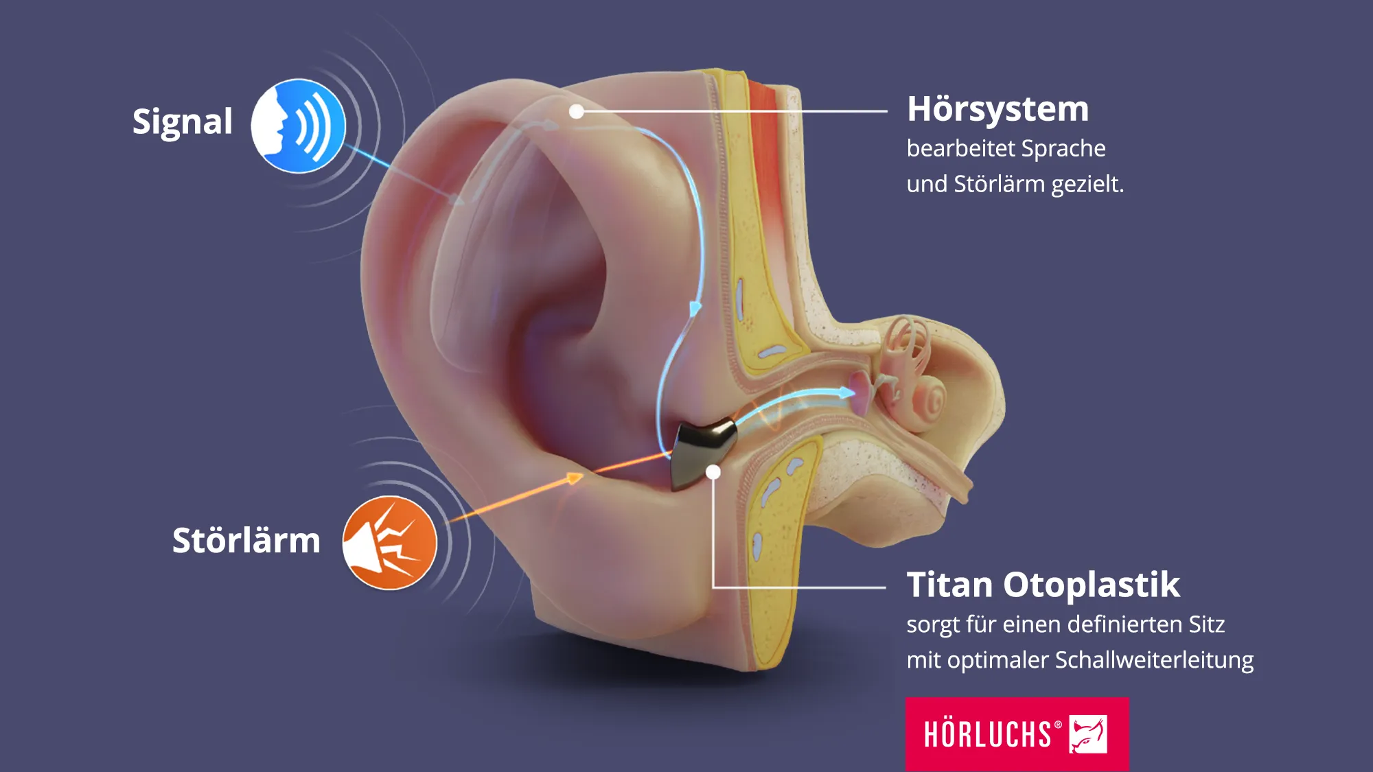 Schnittbild das den Aufbau von Hörhilfen mit Titan Otoplastiken beschreibt
