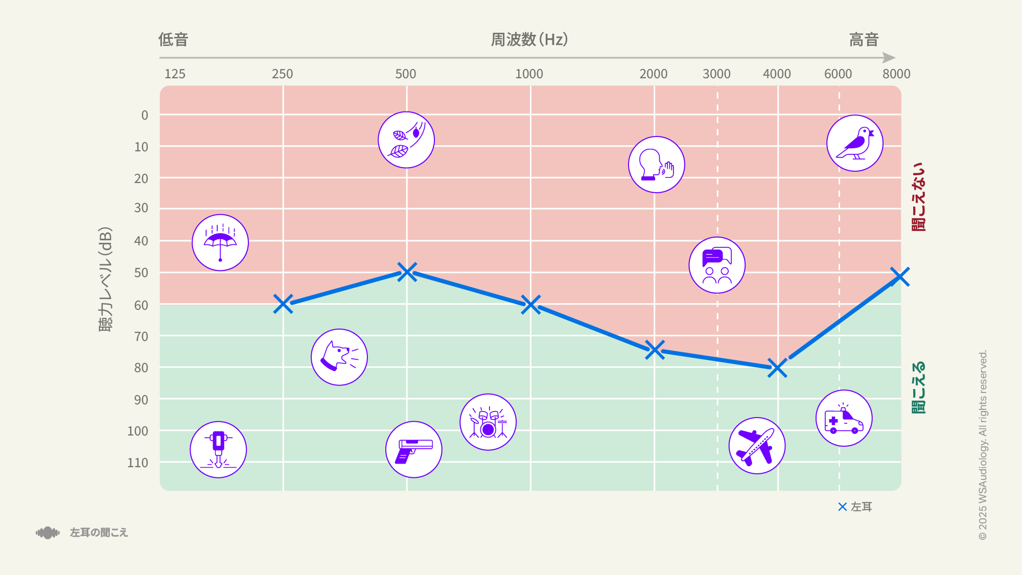 伝音性および感音性の両方を含む混合性難聴を示すオージオグラム。