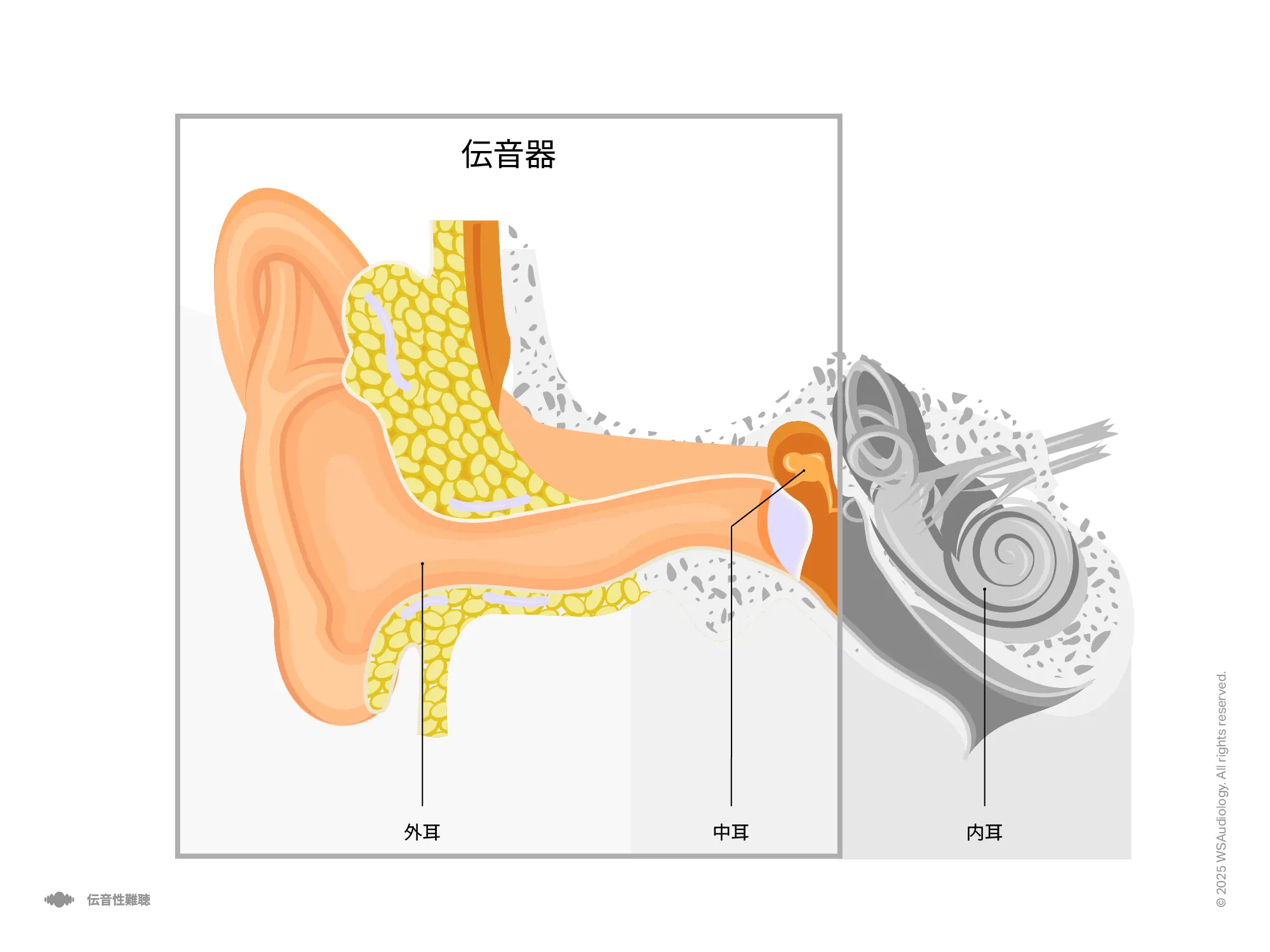 中耳で音が遮られて伝音が減少する伝音性難聴を示すイラスト。