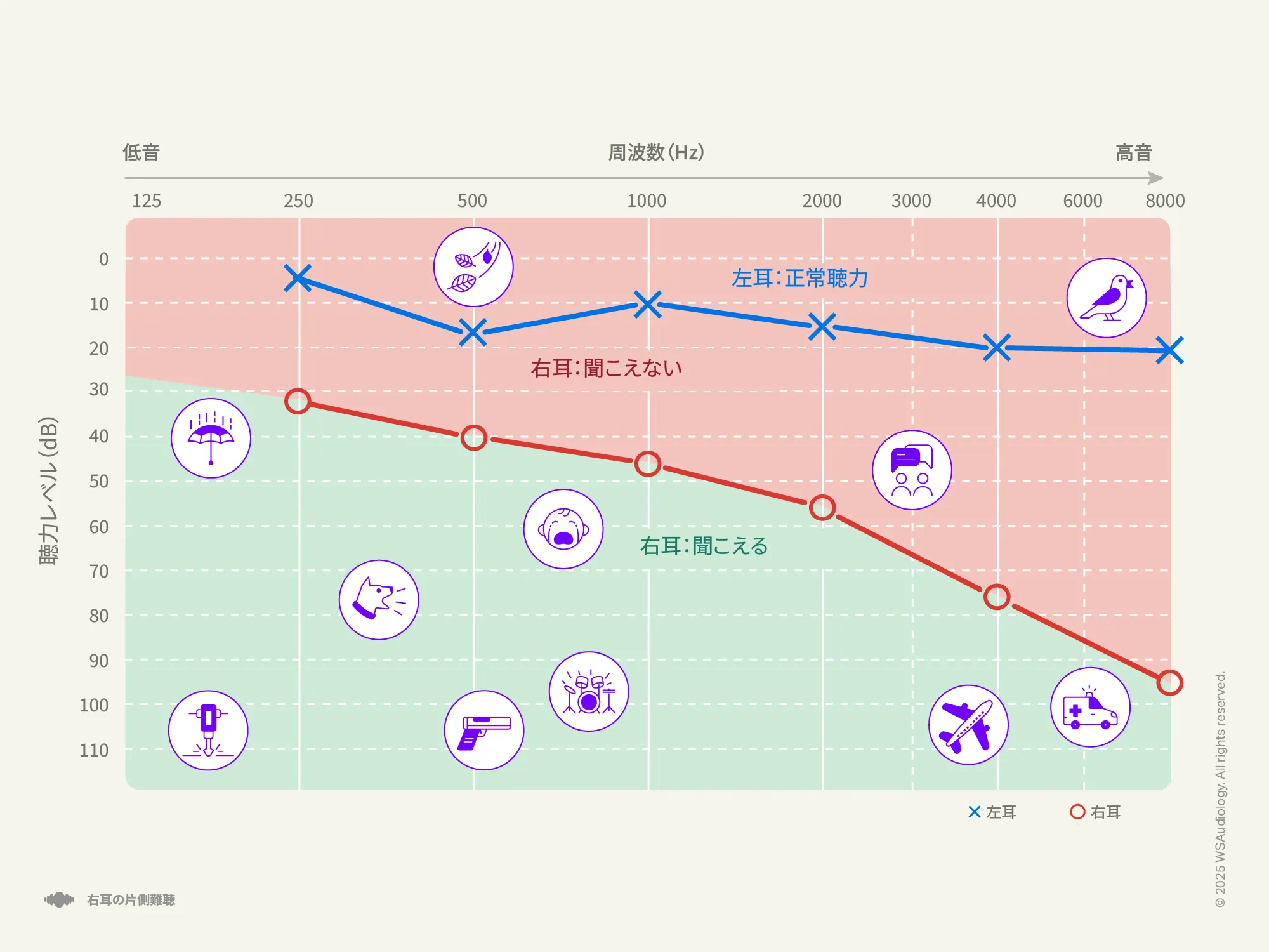 右耳のみに影響する一側性難聴を示すオージオグラム。
