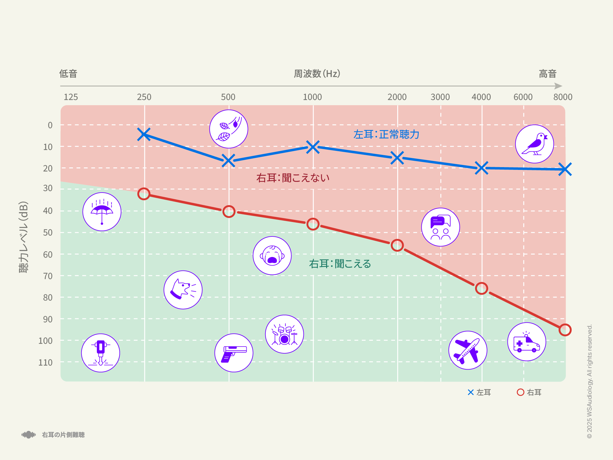 右耳のみに影響する一側性難聴を示すオージオグラム。
