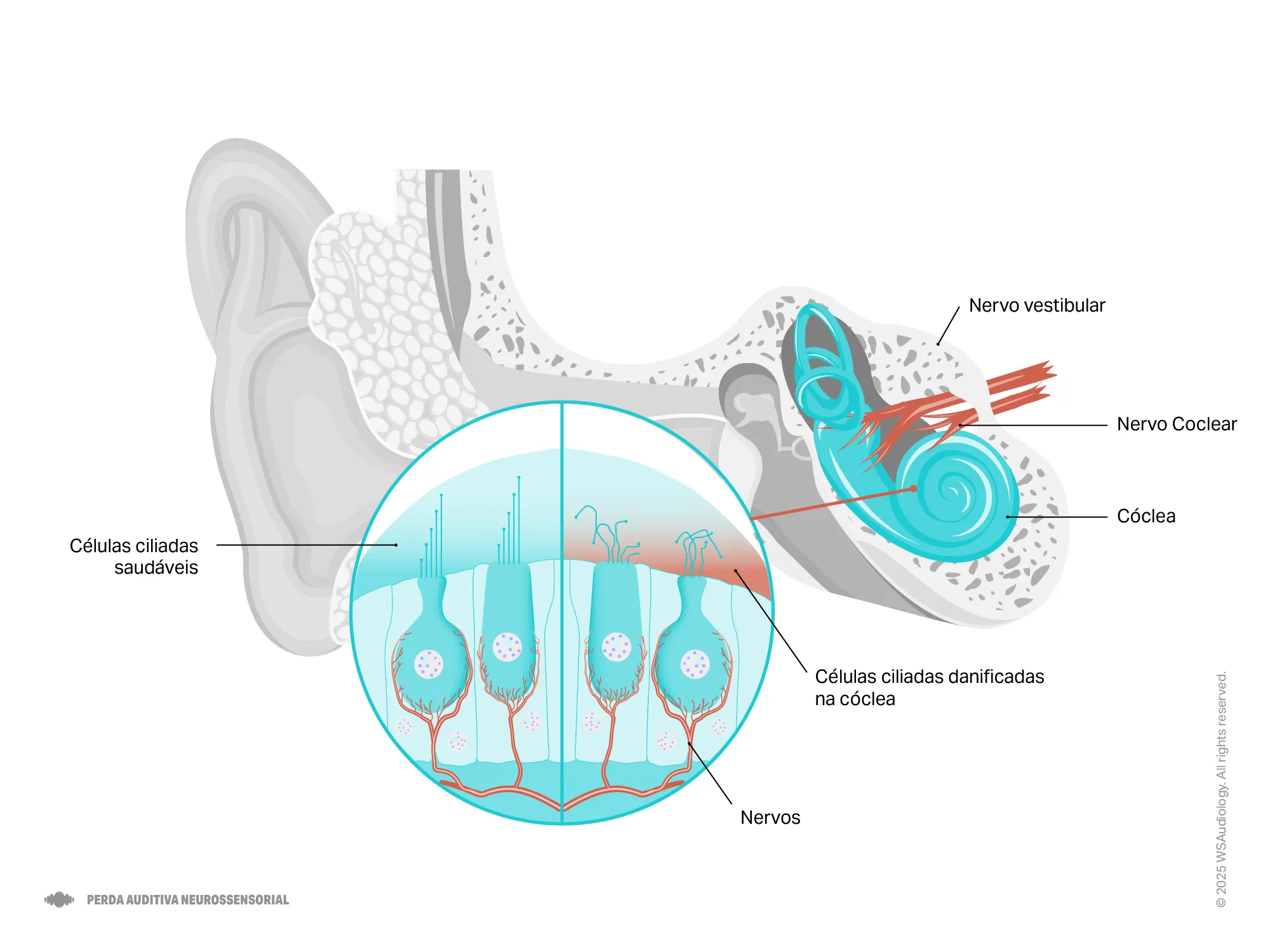Ilustração da perda auditiva neurossensorial mostrando a anatomia do ouvido interno, a cóclea, os nervos auditivos e as células ciliadas danificadas.