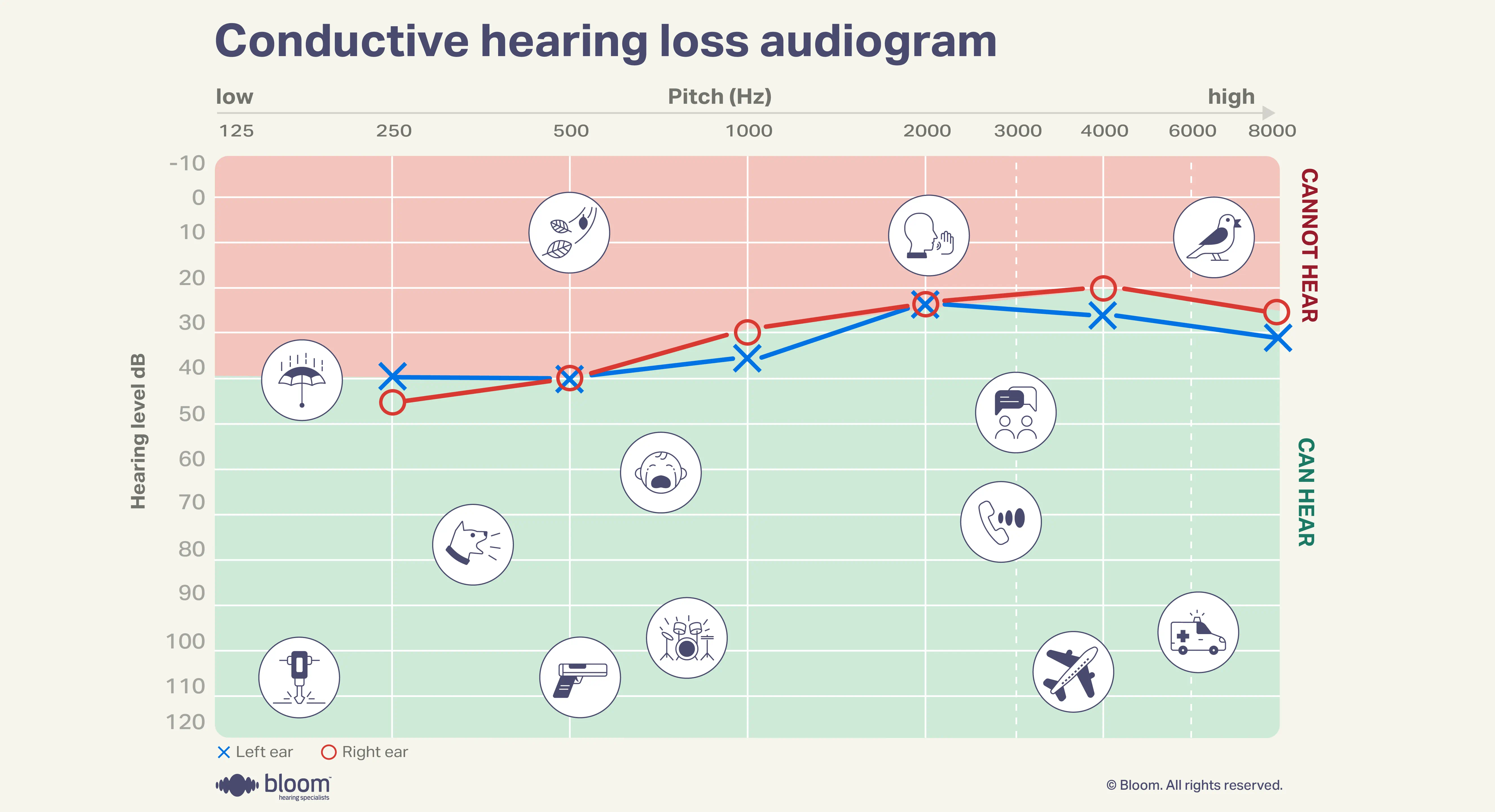 Audiogram representing conductive hearing loss, indicating issues in sound transmission through the outer or middle ear.