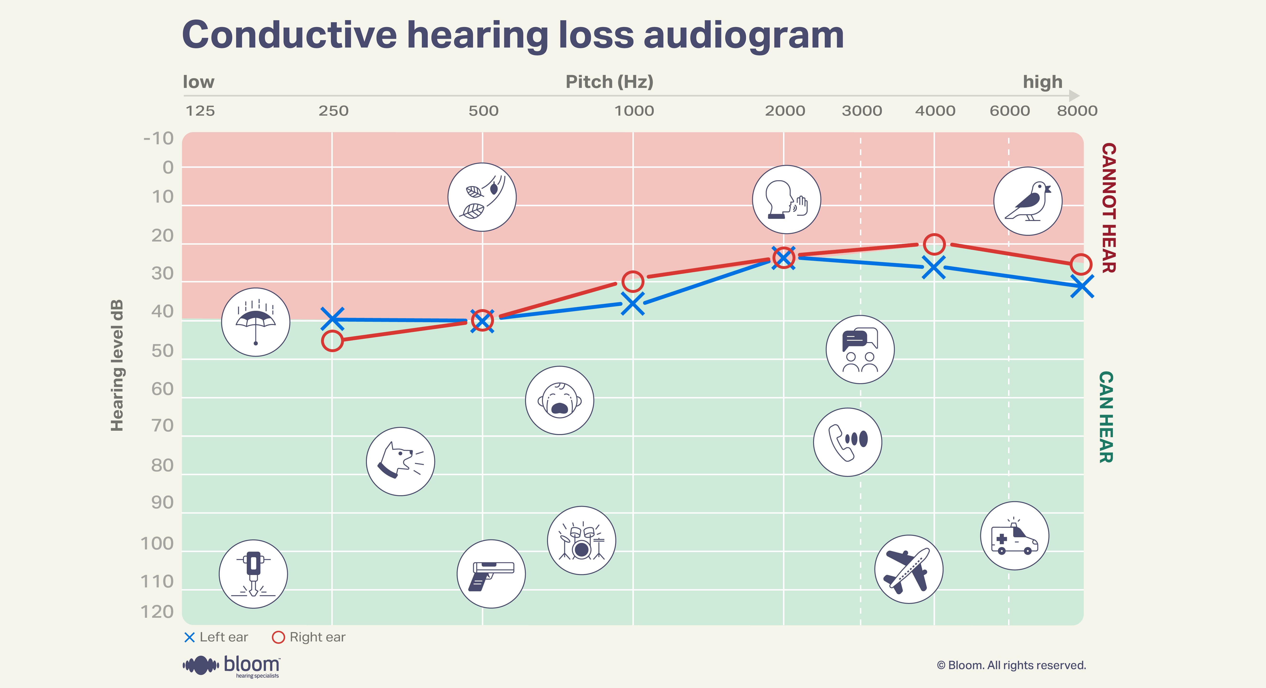 Audiogram representing conductive hearing loss, indicating issues in sound transmission through the outer or middle ear.
