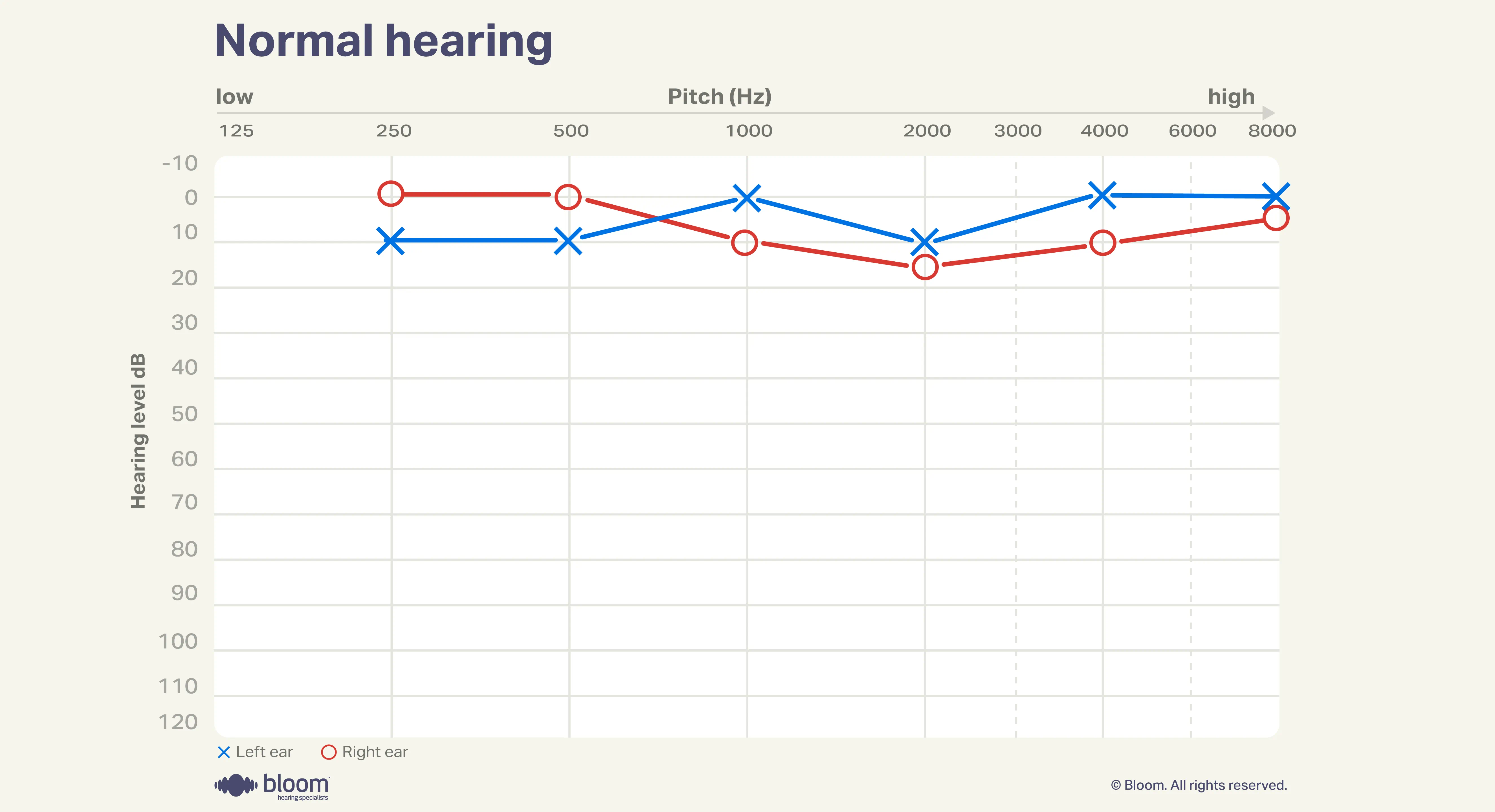 Audiogram representing normal hearing levels.