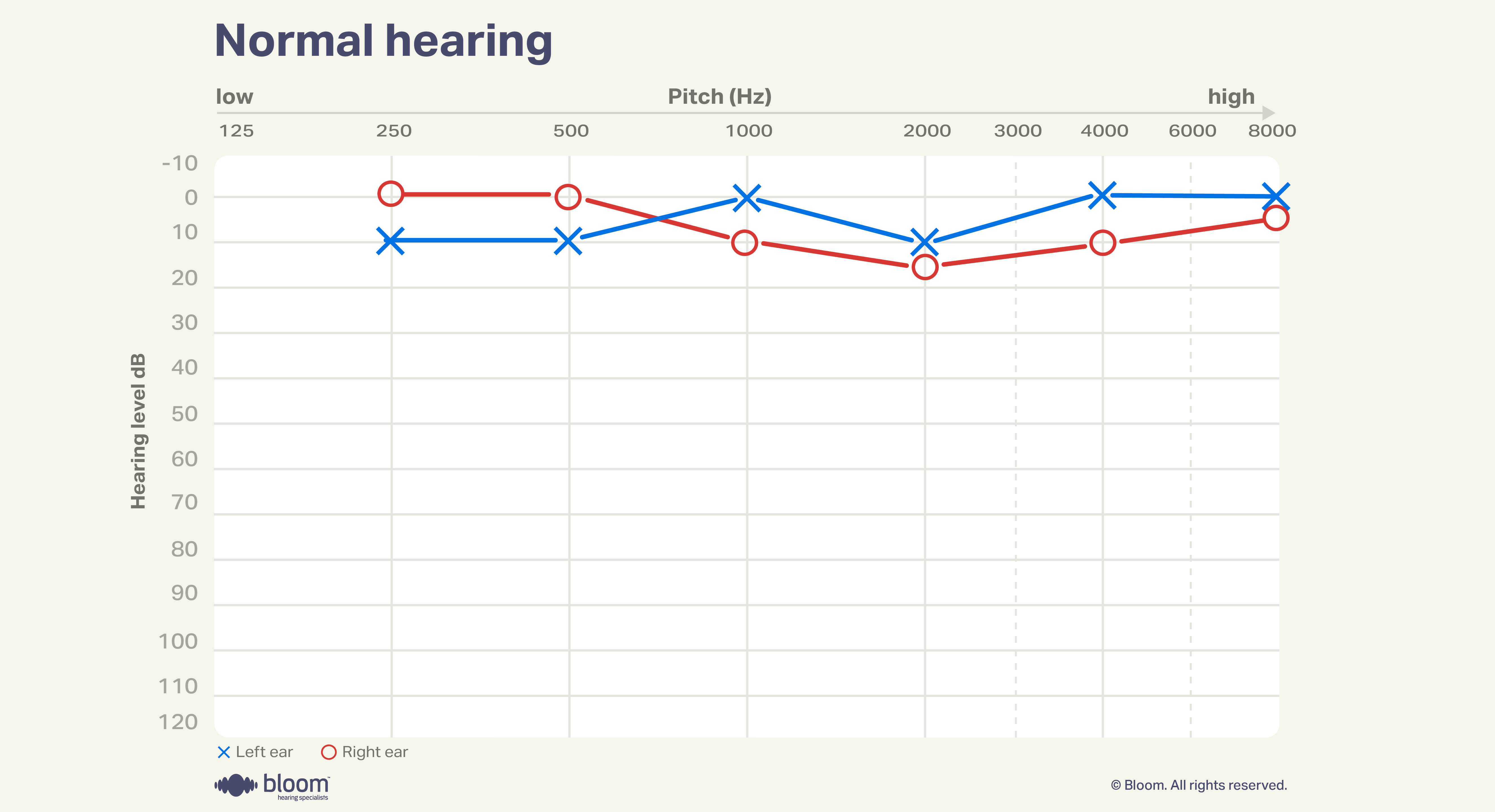 Audiogram representing normal hearing levels.