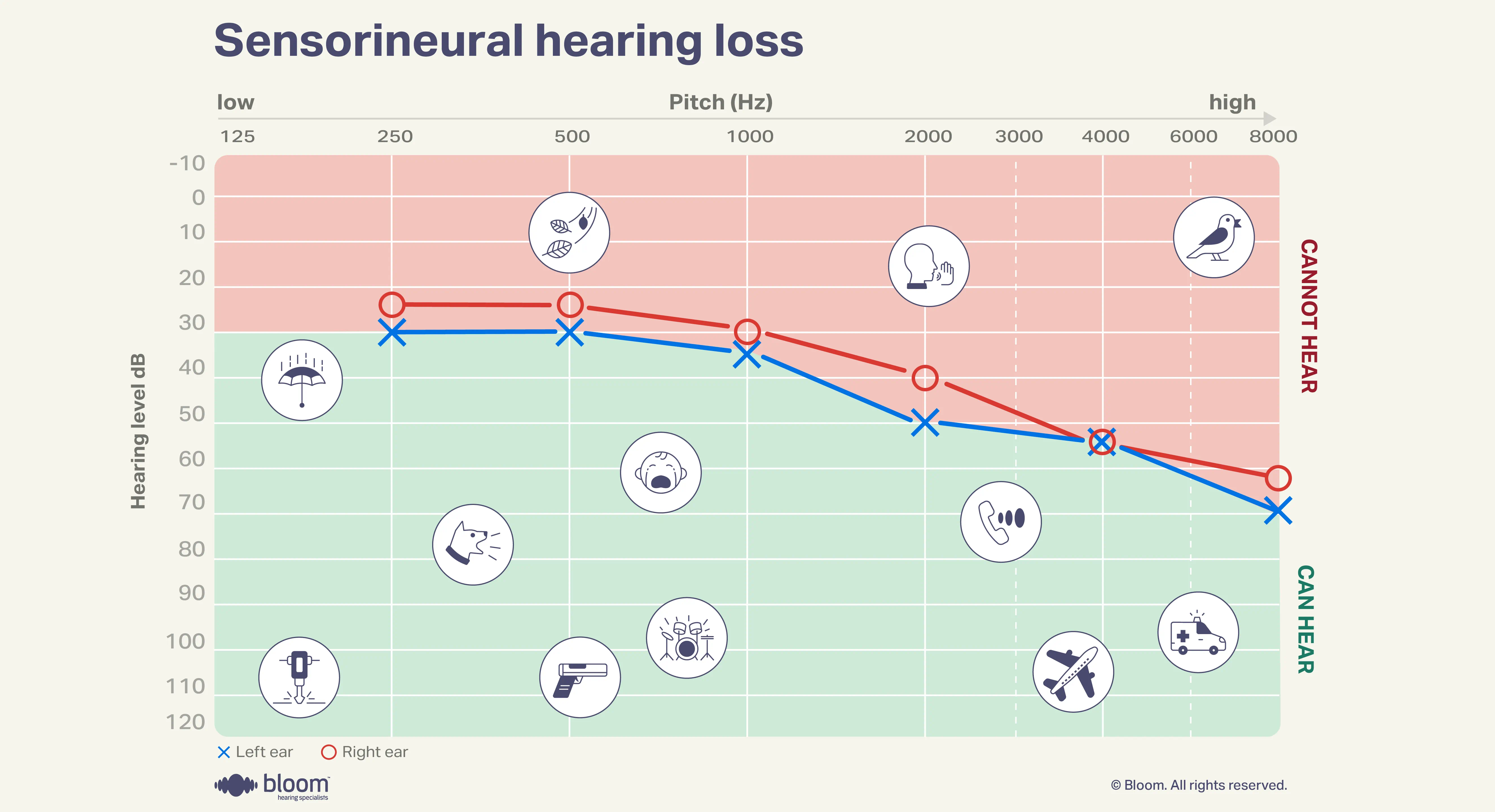 Audiogram showing sensorineural hearing loss, which affects the inner ear or auditory nerve.