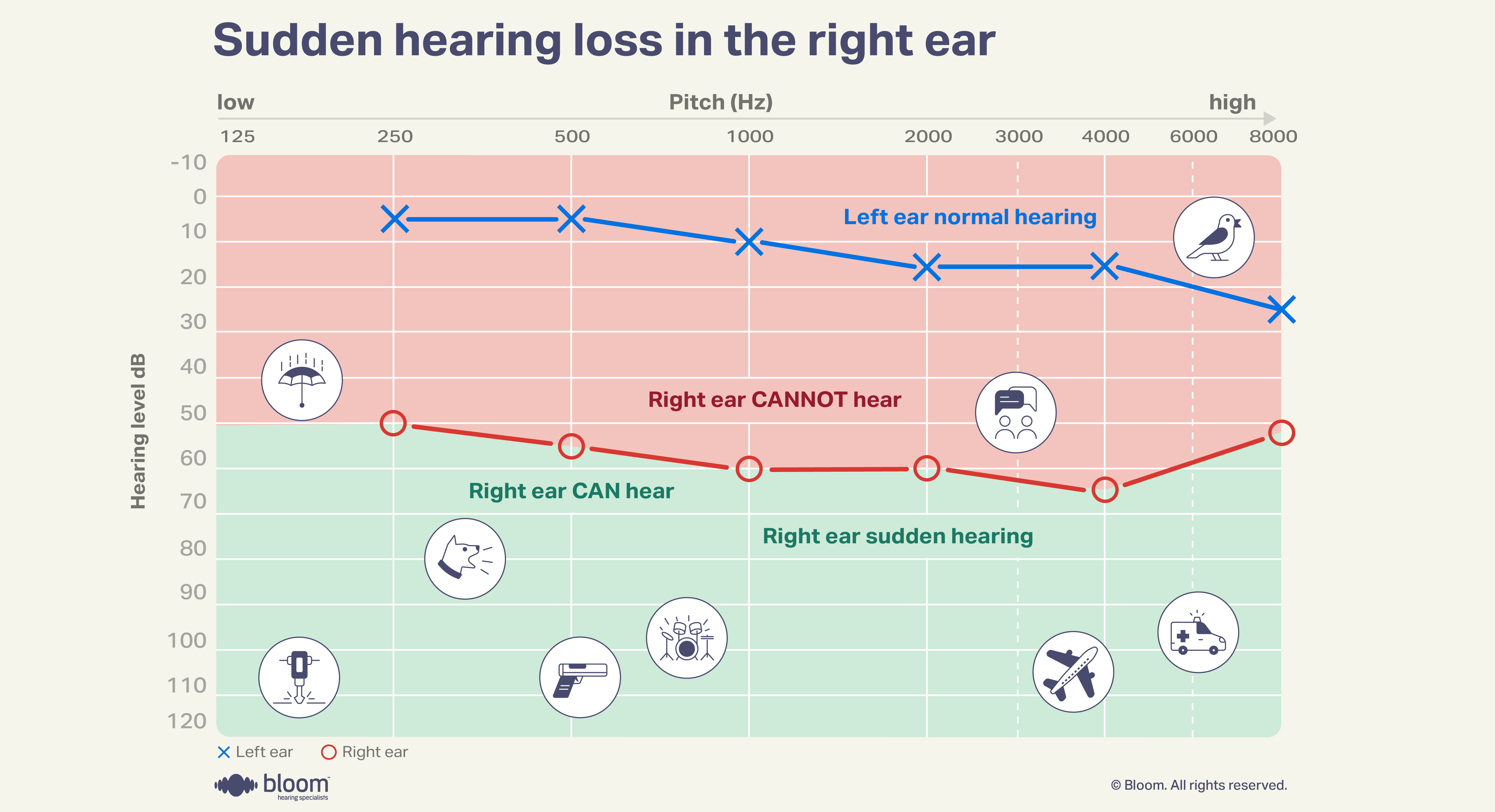 Audiogram illustrating sudden hearing loss in the right ear.
