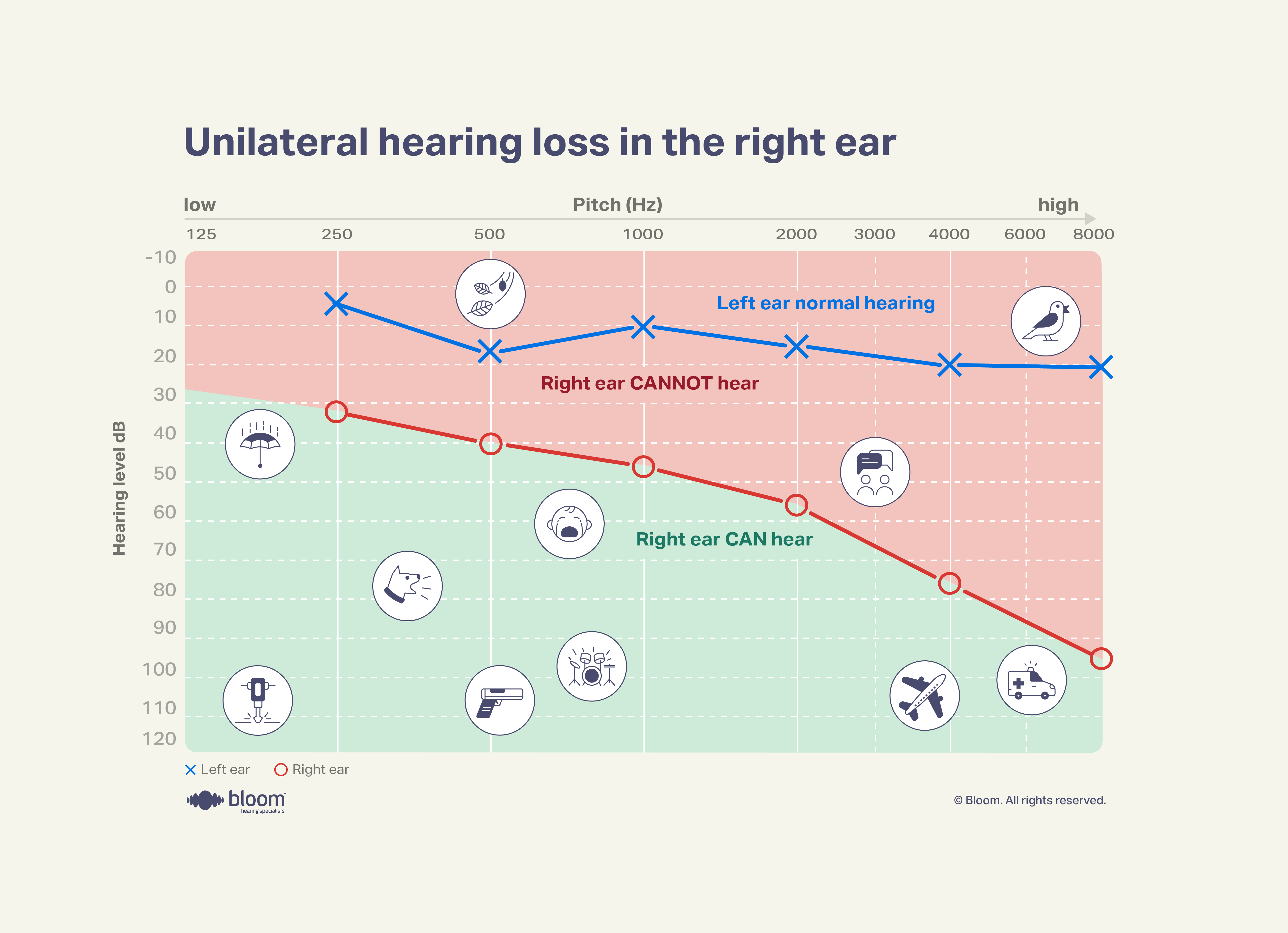 Audiogram showing unilateral hearing loss affecting only the right ear.