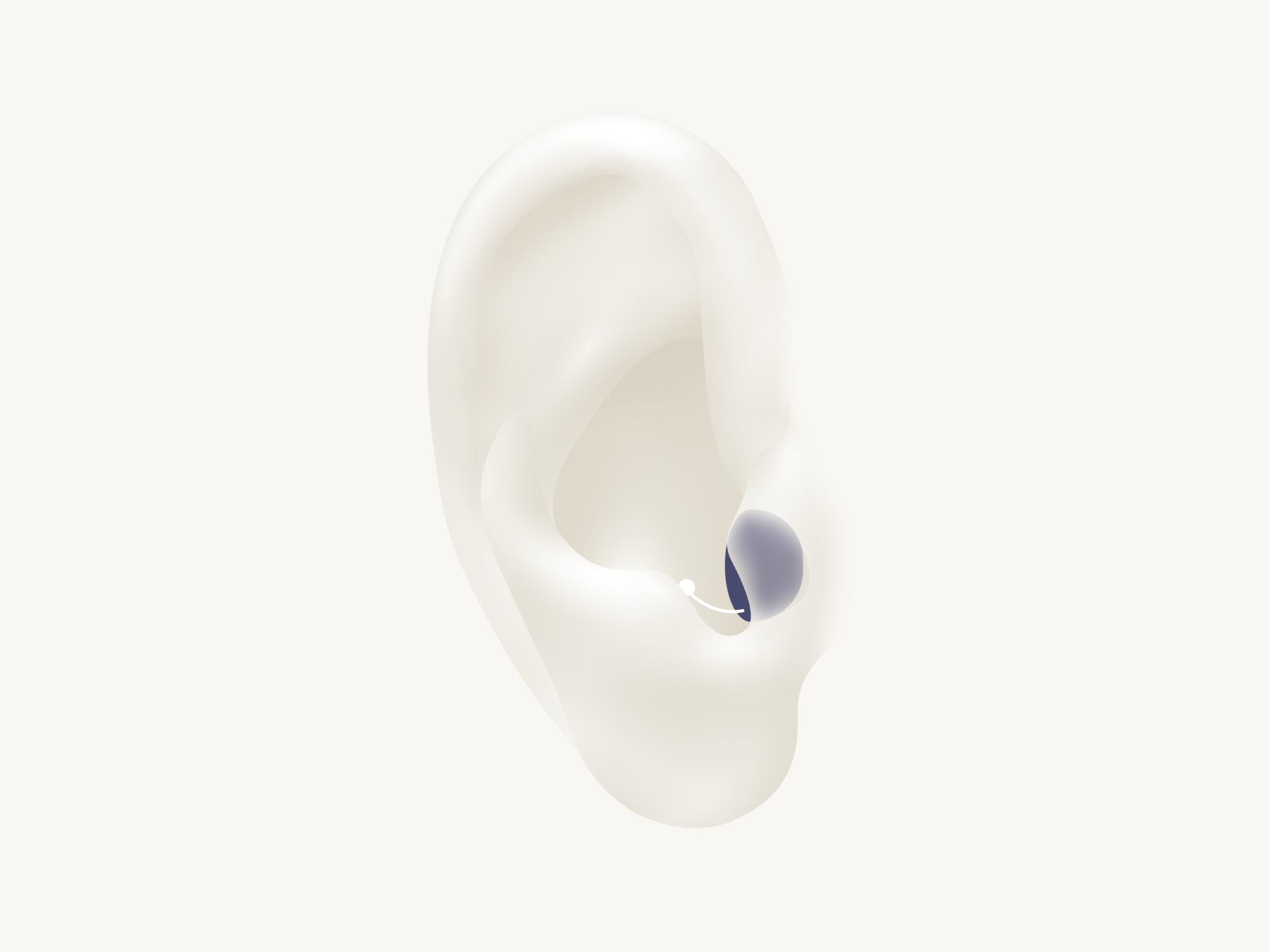 Illustration showing the types of hearing aid called CIC which is worn completely in the ear.
