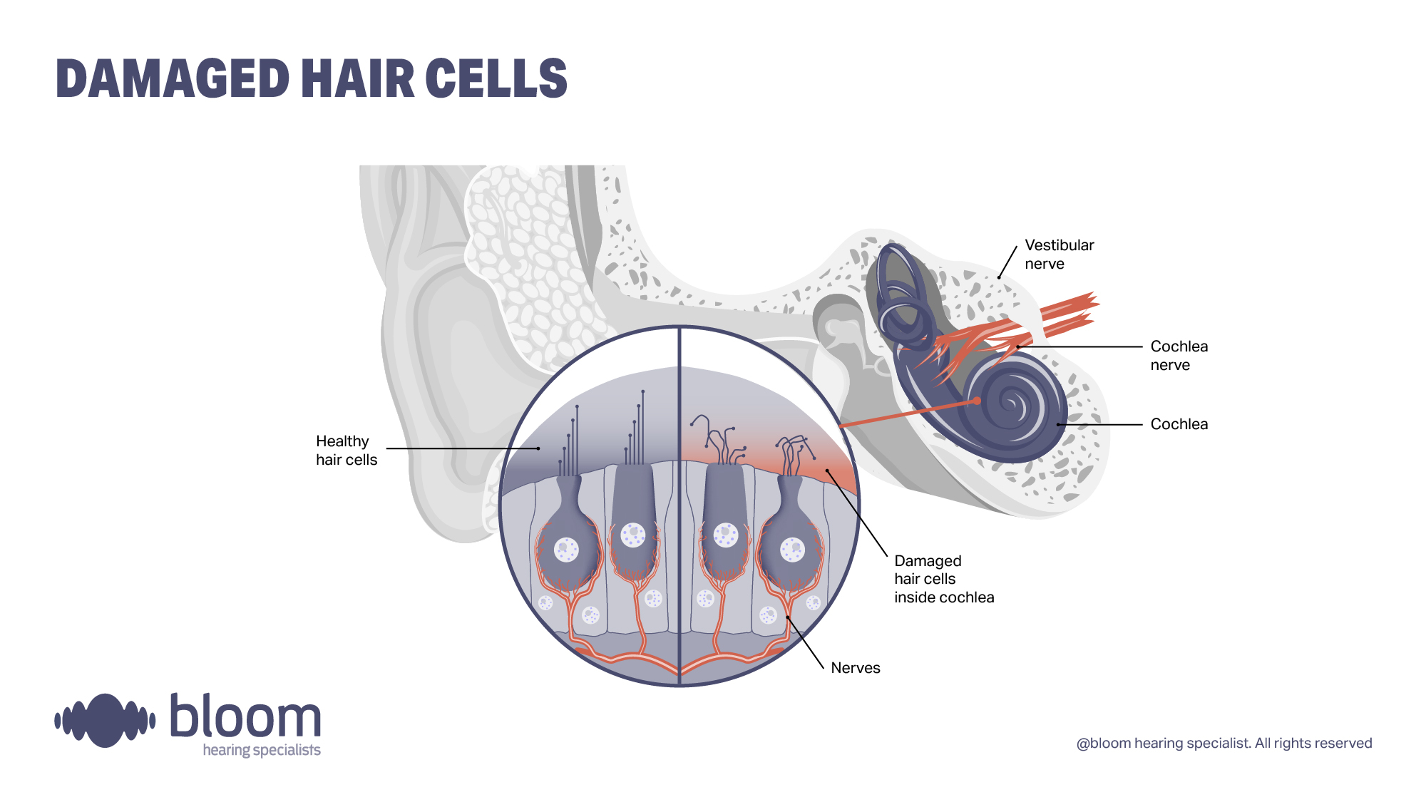 Illustration showing the ear and ear canal how damaged hair cells affect your hearing.