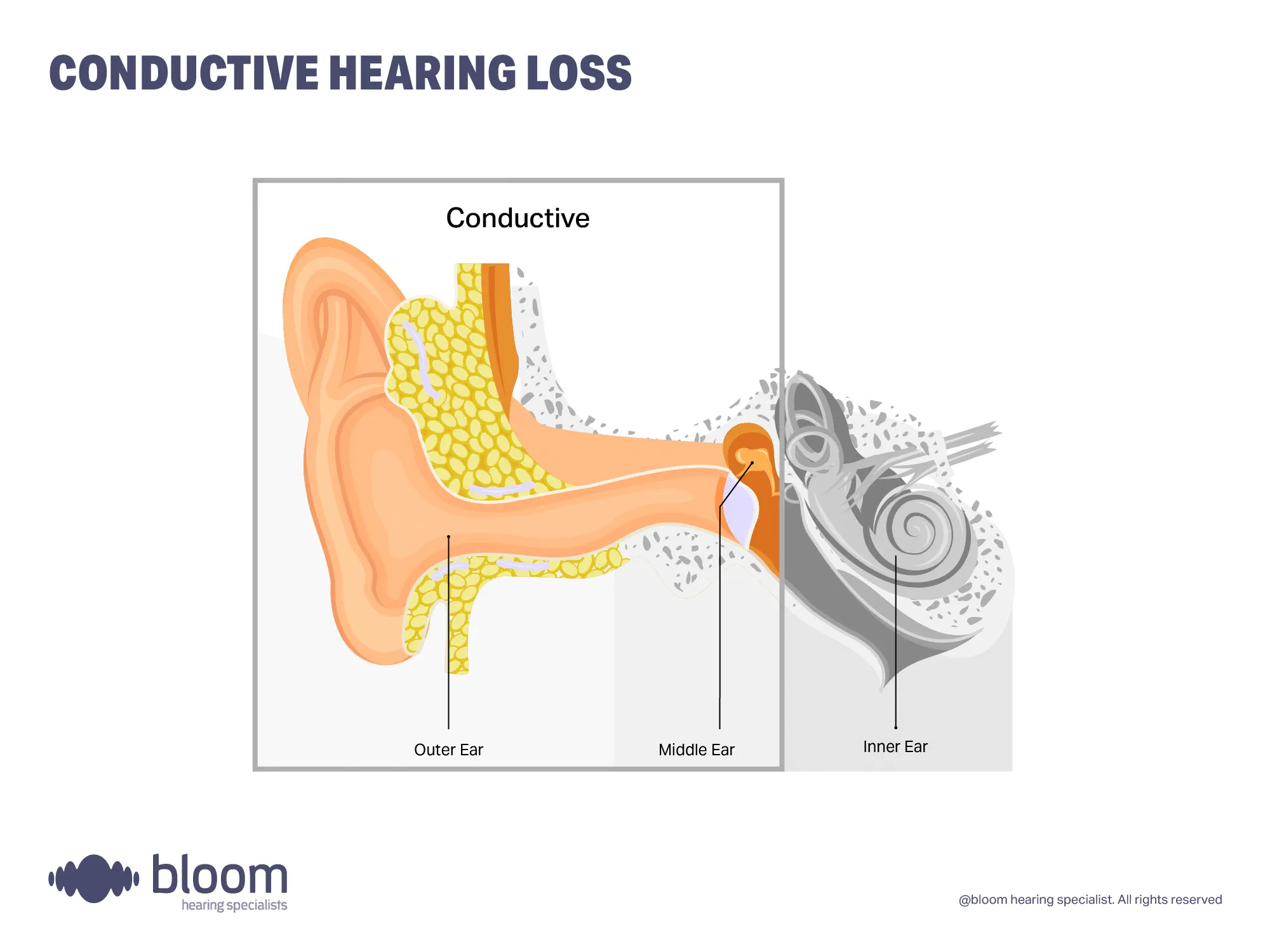 Illustration of conductive hearing loss showing sound blocked in the middle ear reducing sound transmission.