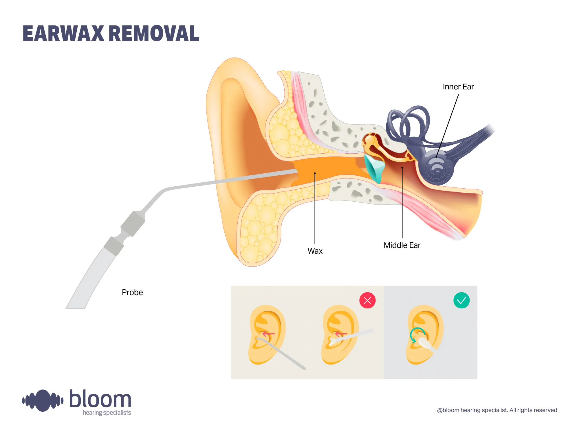 Illustration on how to clean your ears and what not to do.