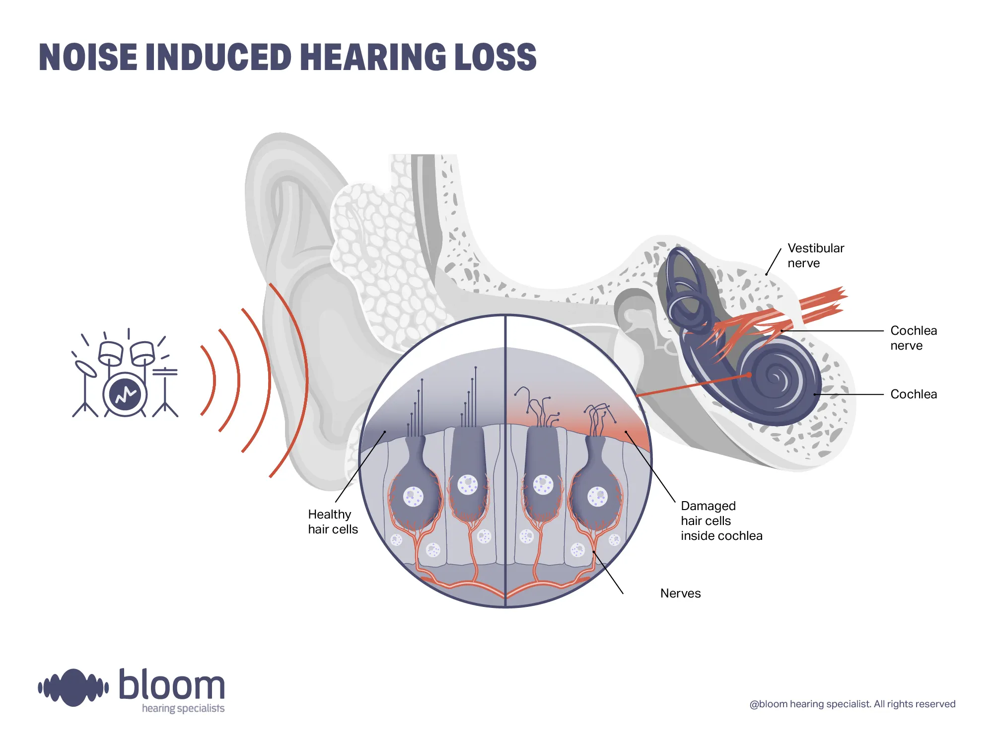 Illustration showing noise-induced hearing loss, showing how exposure to loud noise damages the healthy hair cells and your hearing.