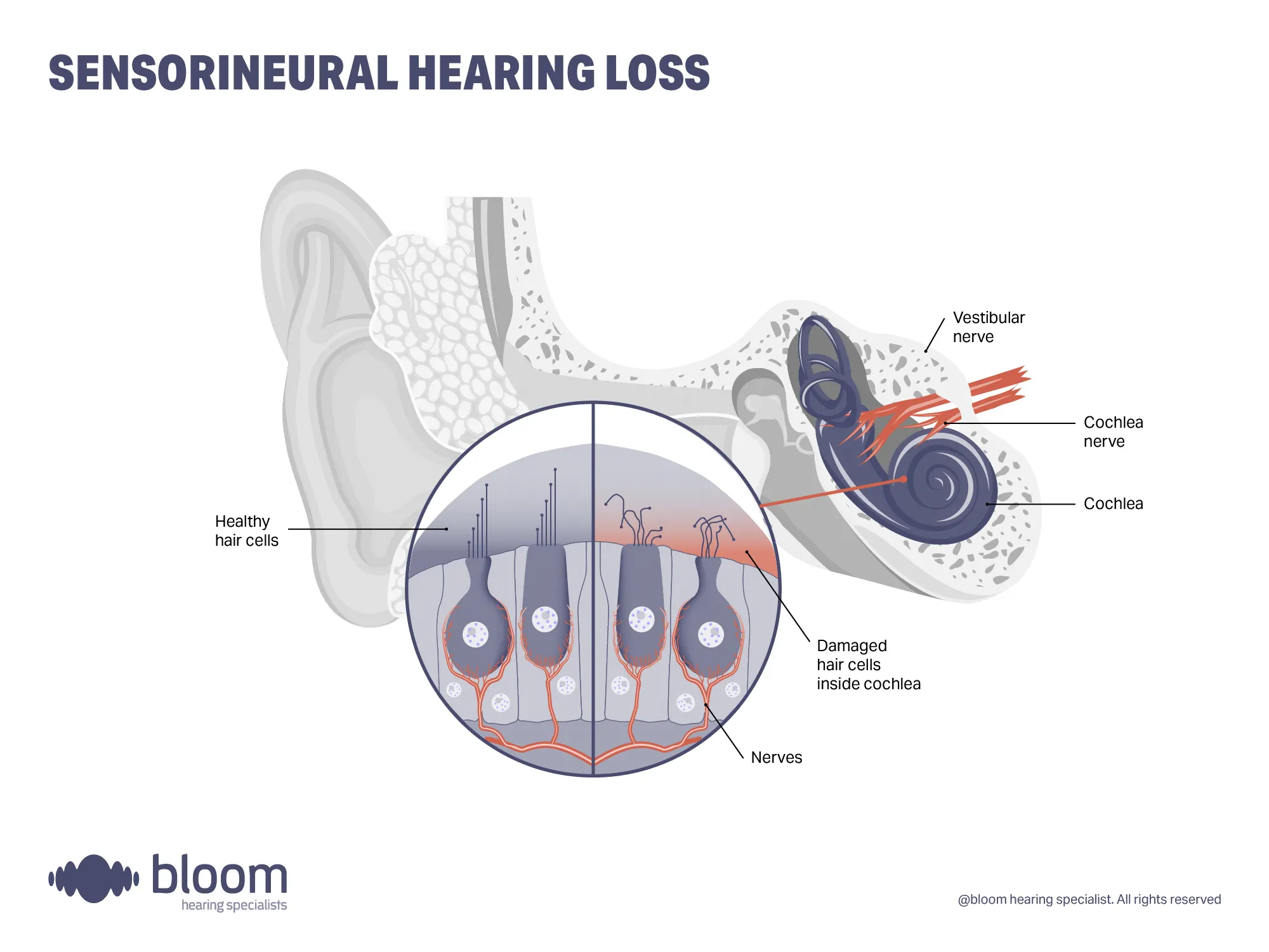 Illustration explaining sensorineural hearing loss, which occurs due to damage in the inner ear or auditory nerve.