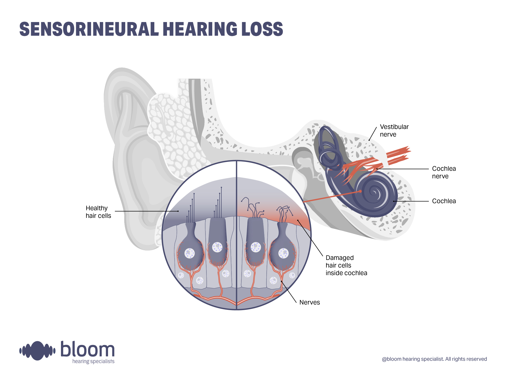 Illustration explaining sensorineural hearing loss, which occurs due to damage in the inner ear or auditory nerve.