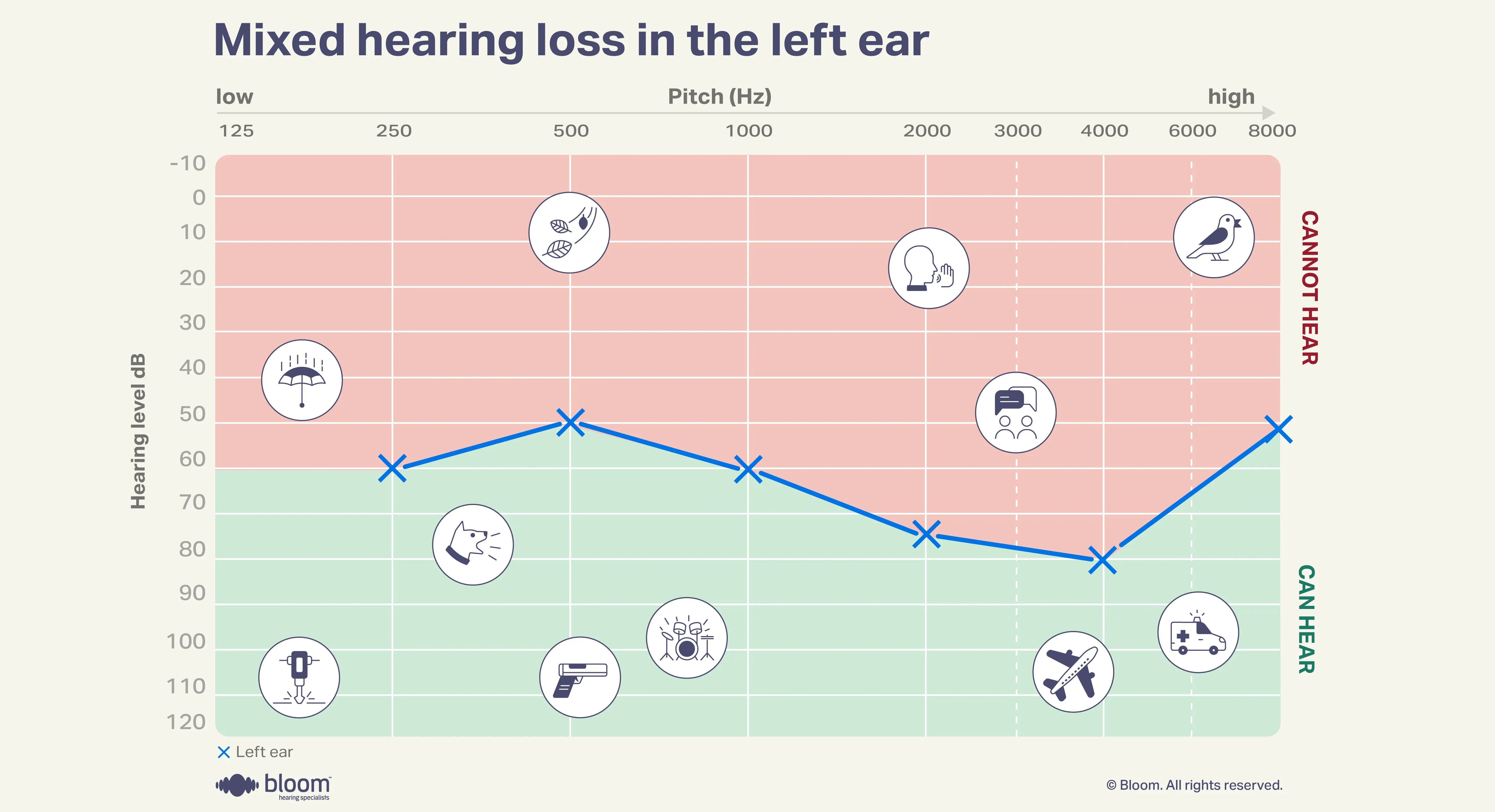 Audiogram demonstrating mixed hearing loss, involving both conductive and sensorineural components.