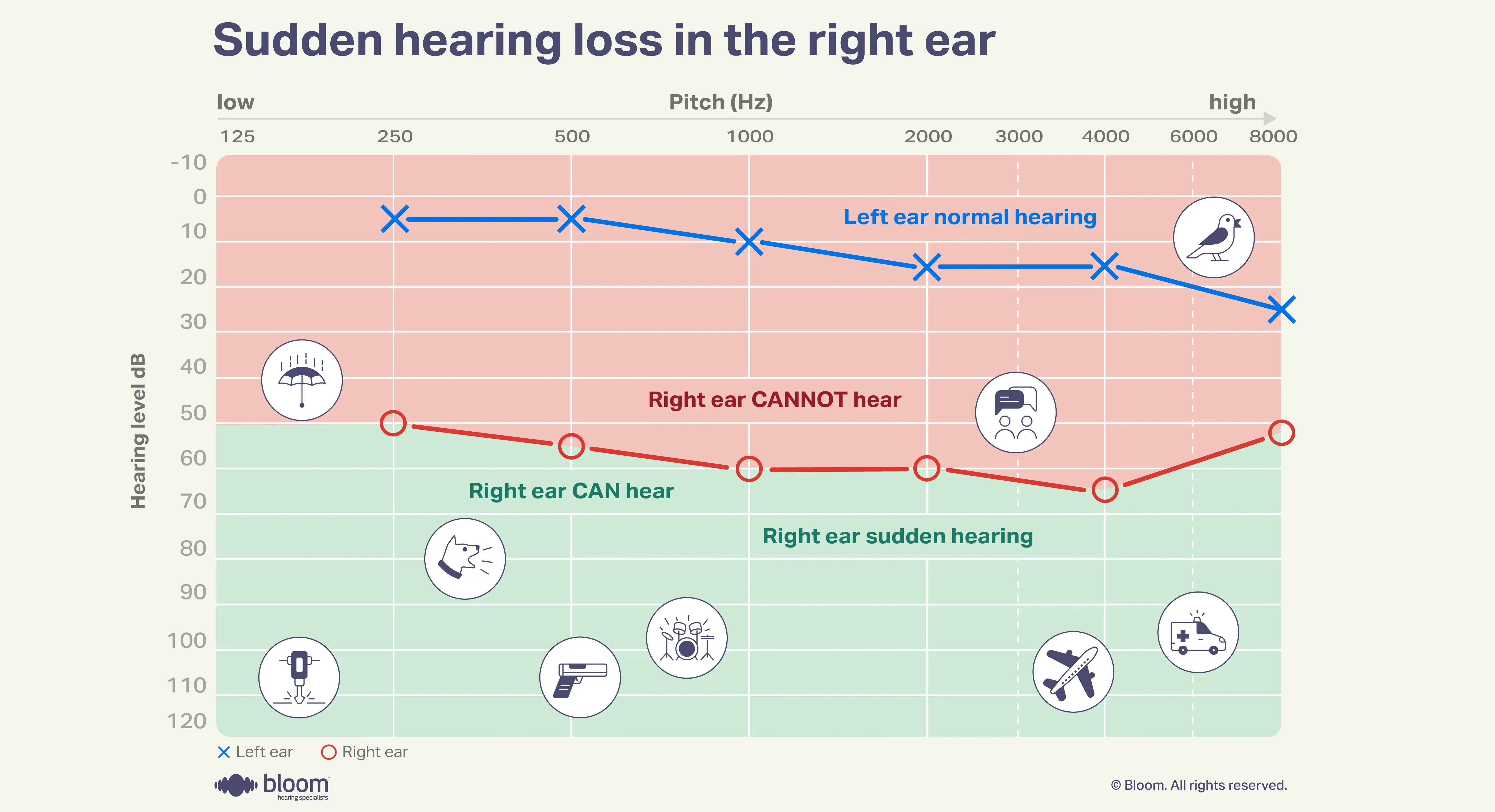 Audiogram illustrating sudden hearing loss in the right ear.