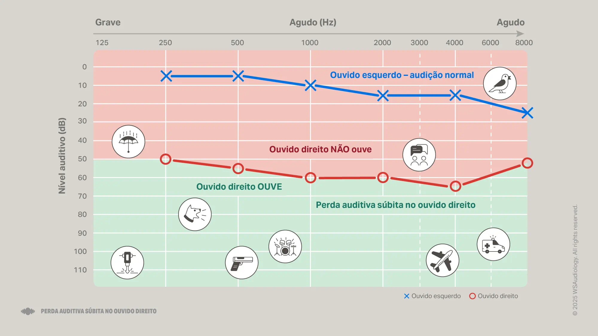 sudden-hearing-loss-audiogram-right-ear-16x9