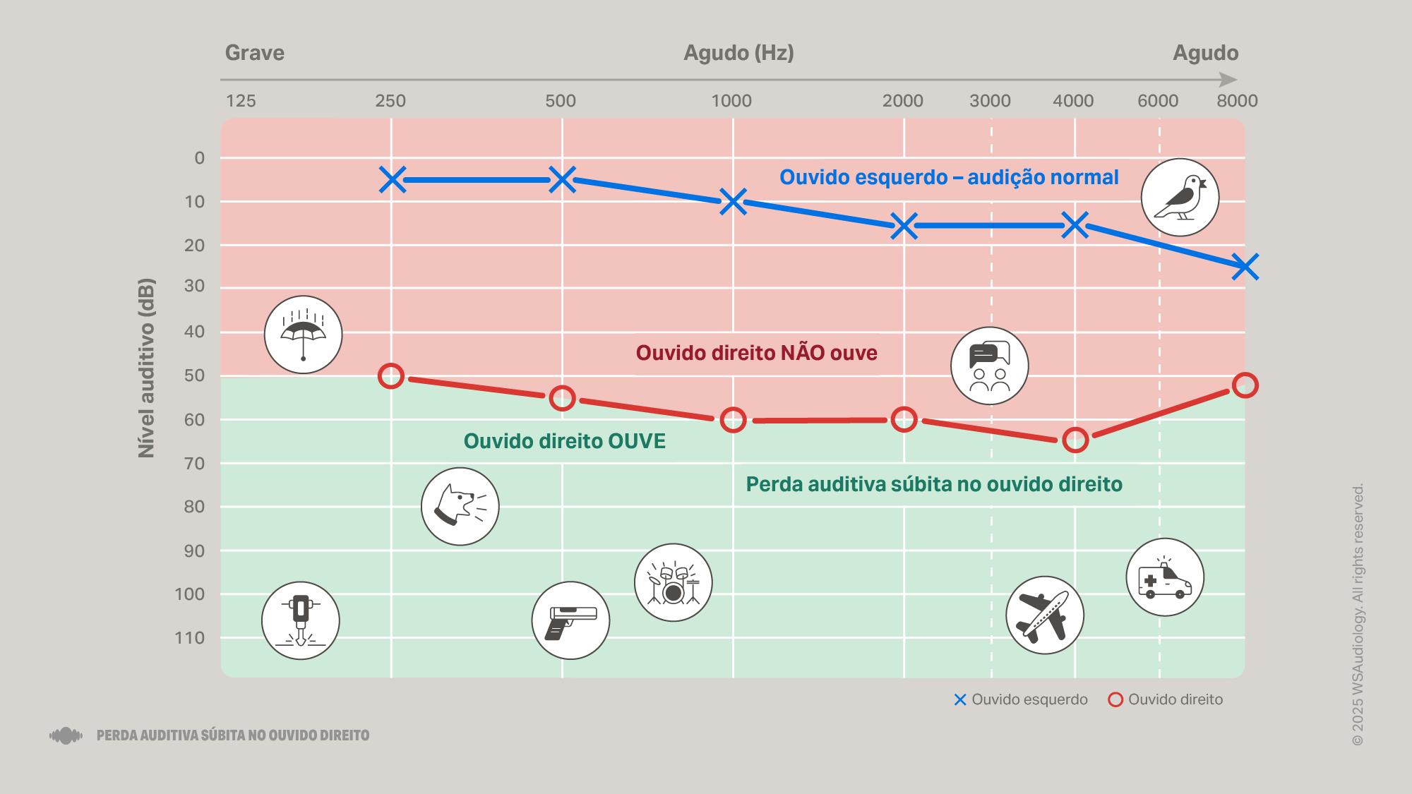 sudden-hearing-loss-audiogram-right-ear-16x9