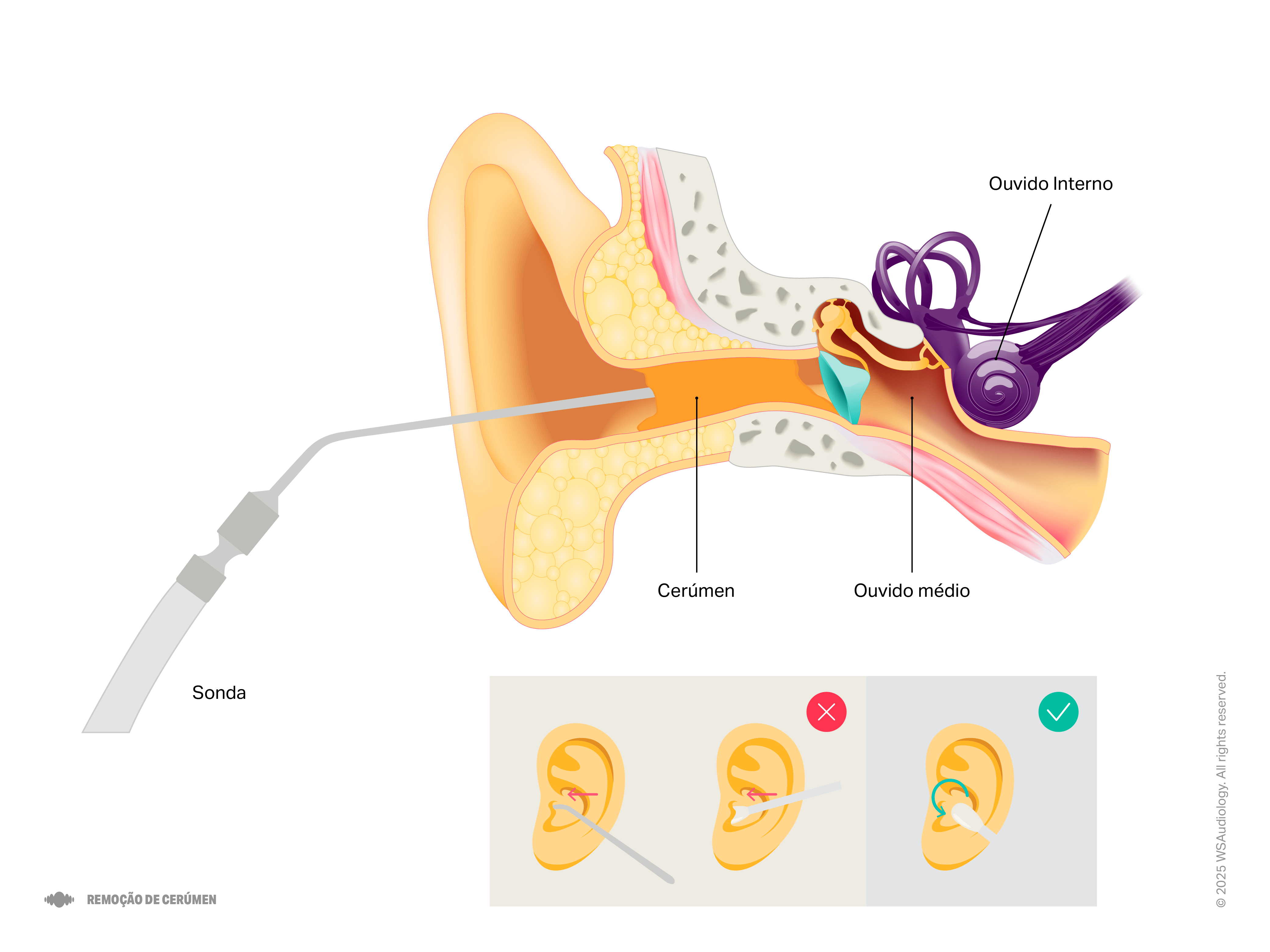 earwax-removal-4x3